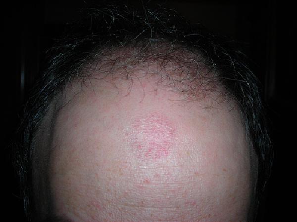Forehead Hickey from suction-cup pen